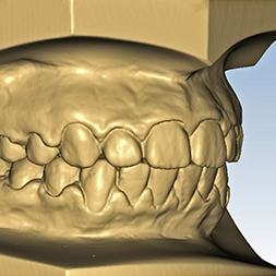 3D Digital Scanning, Sheffield Orthodontic Lab